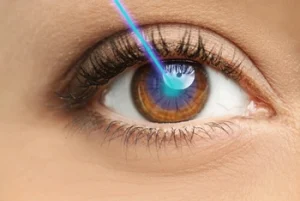 Vision After Cataract Surgery eye Vision After Cataract Surgery eye